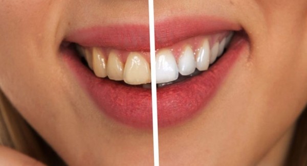 Причины появления желтого налета на зубах и способы его устранения Причины появления желтого налета на зубах и способы его устранения